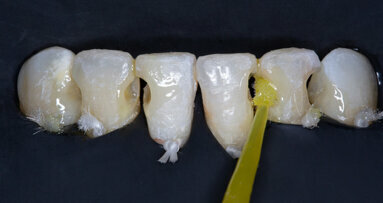 Simplified direct restoration procedure in the mandibular anterior region with CLEARFIL MAJESTY ES-2 Universal