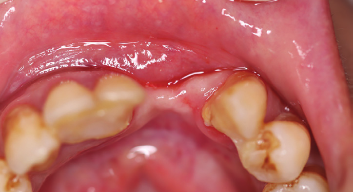 Figure 3: Occlusal intraoral view showing the advanced amount of bone loss.