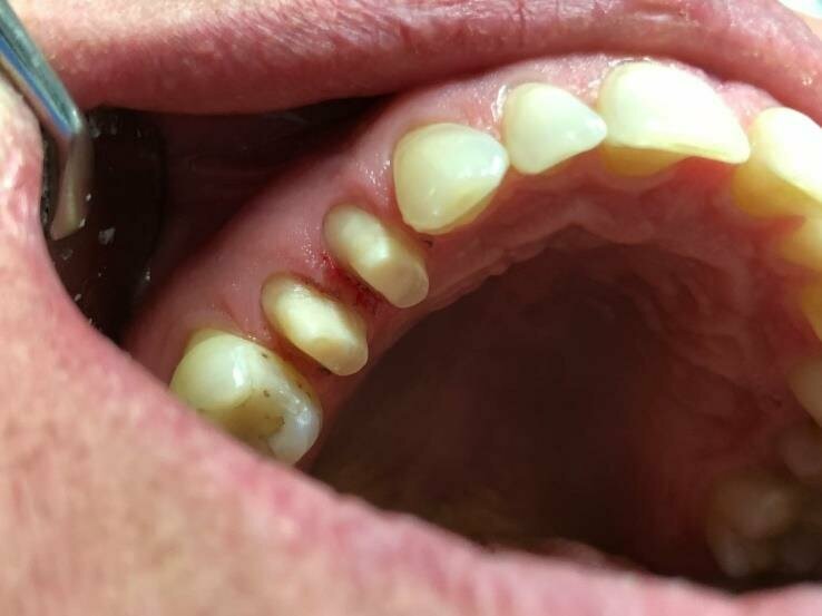 Fig. 1: Teeth preparation