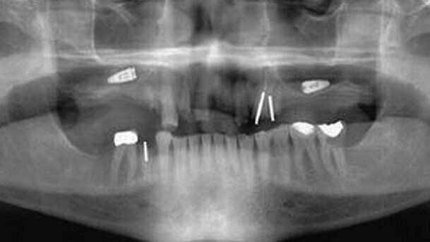 Prévention des échecs en implantologie orale