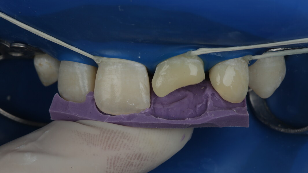 Fig 14: The silicone index was then used to build the palatal shell which served as the base to further layer composite.