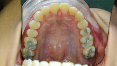 Study reveals environmental impact of dental amalgam