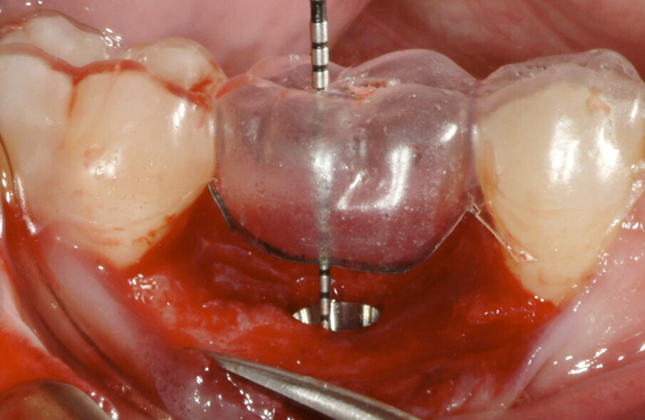 Fig. 7: The implant was placed 3 mm apical to the cervical contour of the planned restoration, symmetrically from
the mesial to distal aspect, and 2 mm to the lingual aspect in order to preserve the buccal bone that would support the soft tissue.