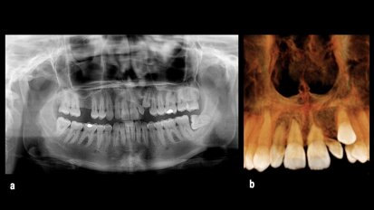 Abordaje mínimamente invasivo en ortodoncia