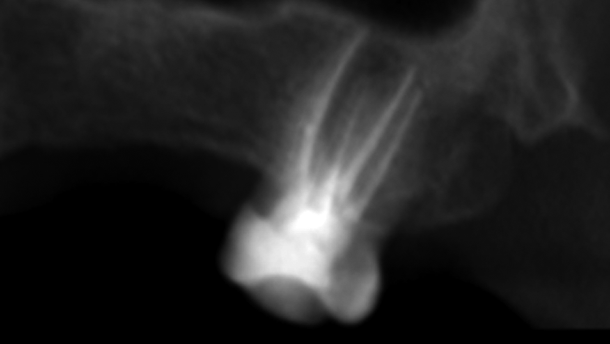 Diagnosis and management of a rare case of a maxillary second molar with two palatal roots - Supported by conventional radiography and CBCT