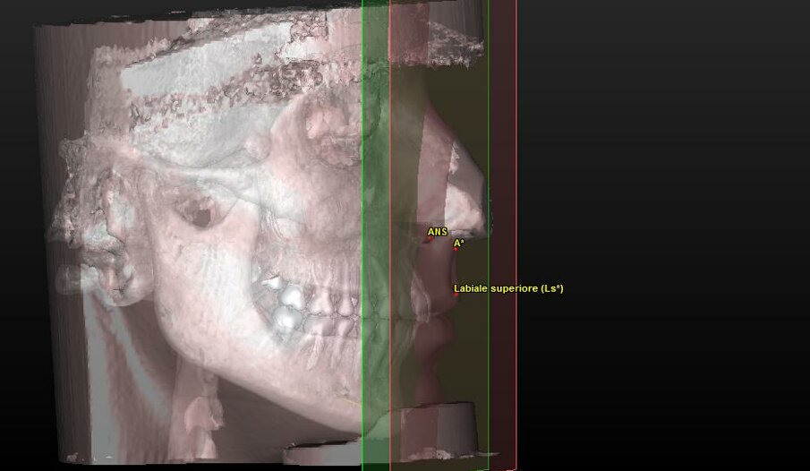 Figg. 5, 6_Piani di riferimento per la costruzione dell’analisi cefalometrica 3D, secondo la metodica cefalometrica Total Face Approach.