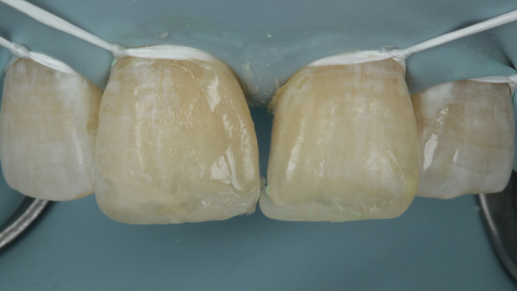 Fig 13. The proximal wall was first built on right central incisor taking support from the matrix band. The desired contour is achieved on right central incisor.