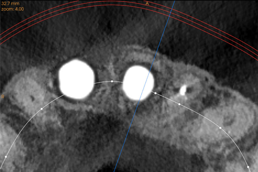 Fig. 27a: The post-op CBCT scan axial view revealed the intact crescent shape of the root membrane (a), as outlined in red in facial to the opaque
implant position (b).