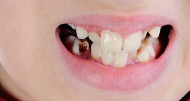 30% rodziców pozwala swoim dzieciom na zaniedbywanie higieny jamy ustnej