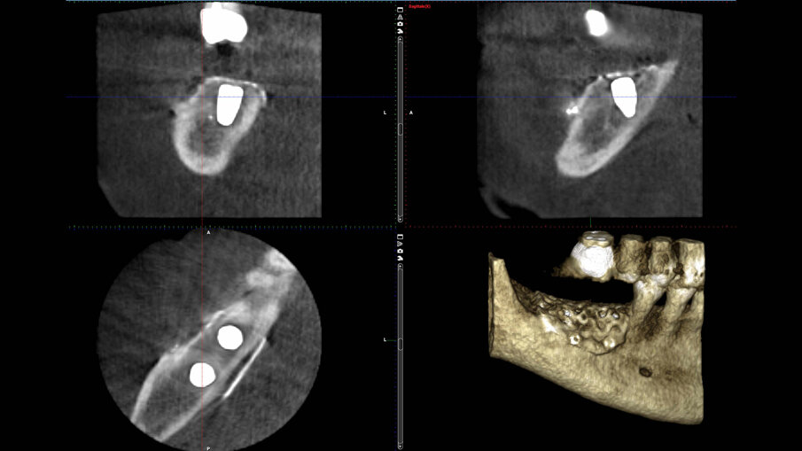 Figg. 8a, 8b_OPT e sezioni di CBCT dopo l’intervento che mostrano l’incremento osseo ottenuto.