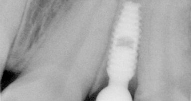 Aproximální rozšíření mezi kořeny zubů za účelem zavedení úzkého implantátu