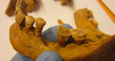 Middeleeuws tandsteen toont verandering van oraal microbioom