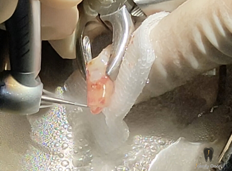  Figg. 5a-5d - Chirurgia apicale. Retro-preparazione con punte ad ultrasuoni (a & b) e retro-otturazione con CeraPutty (Meta Biomed) (c & d).