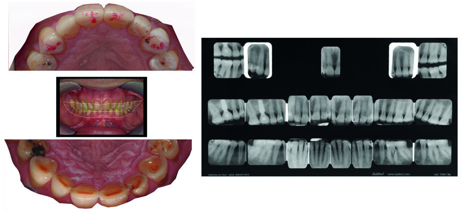 16 o Mock-up estetico - Modifica dell'estetica dentale in resina con  utilizzo della mascherina diagnostica - STUDIO NEZZO