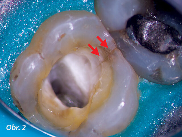 Vyhodnocení rozsahu meziální lomové linie (šipky) u levého druhého horního moláru. Mikroskopické vyšetření potvrdilo nutnost rekonstrukce.