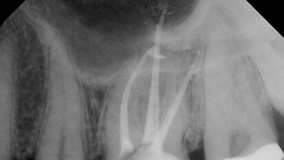 Answers to common clinical endodontic questions: Three basic concepts explained