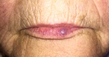 Caso clínico: Tratamiento con láser de malformaciones vasculares del labio inferior