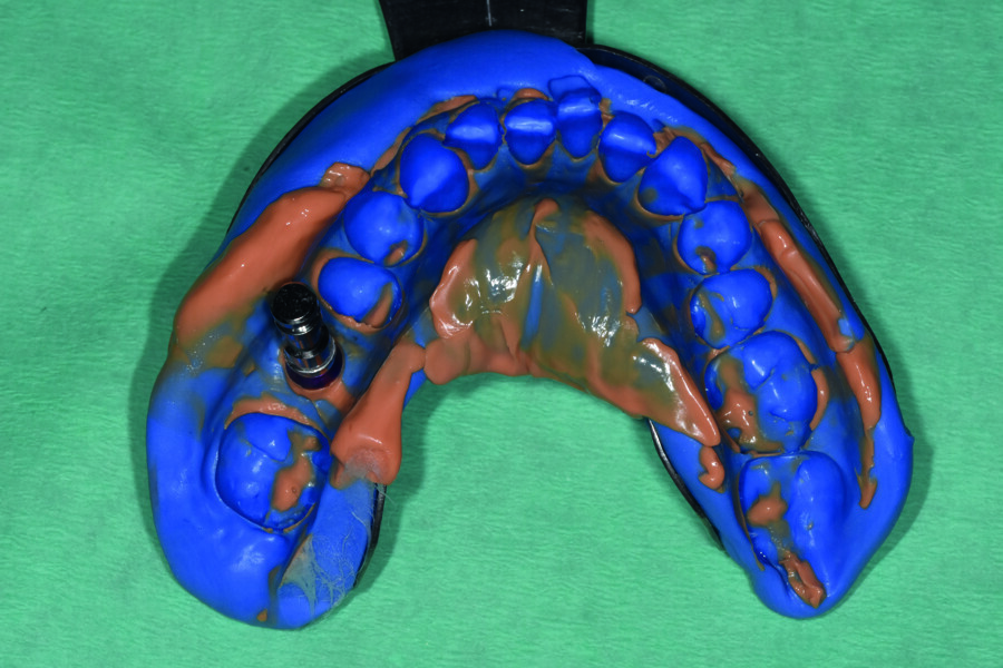 Fig. 17 : Analogue d’implant vissé sur le transfert repositionné dans l’empreinte. 