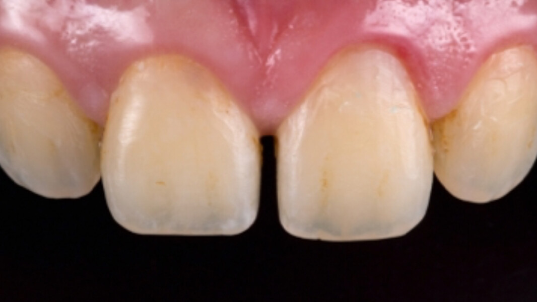 Fig. 1. Situación de partida: paciente joven con diastema entre los dientes 11 y 21.