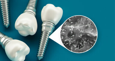 Dentistry at nanoscale: how nanotechnology advances the properties of dental implant surfaces