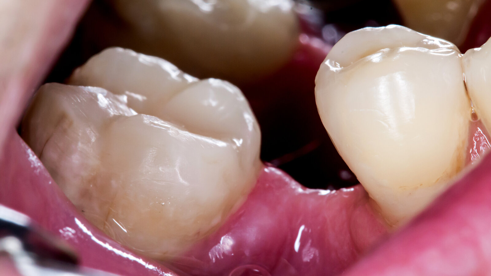 Rast novih zuba: Istraživači slede „san svakog stomatologa“