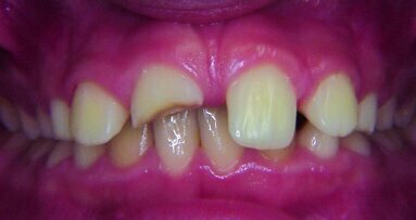 Les lasers dans le traitement de dents antérieures, fracturées à la suite d’un traumatisme