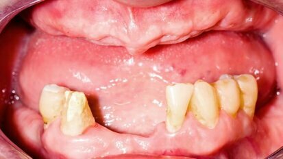 Izguba zob je lahko povezana z nižjo kognitivno funkcijo