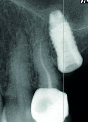 Après une séance d’ostéoactivation, pose à 45 jours d’un implant Fractal®, le gain osseux obtenu à
l’apex de l’implant est bien visible à la radiographie de contrôle.