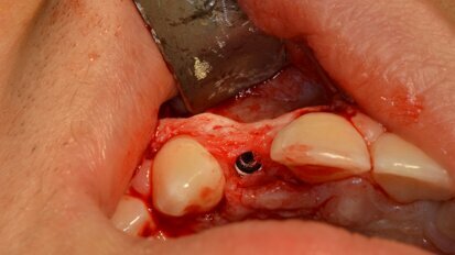 Alveolar deficiency management in lateral upper incisor agenesis
