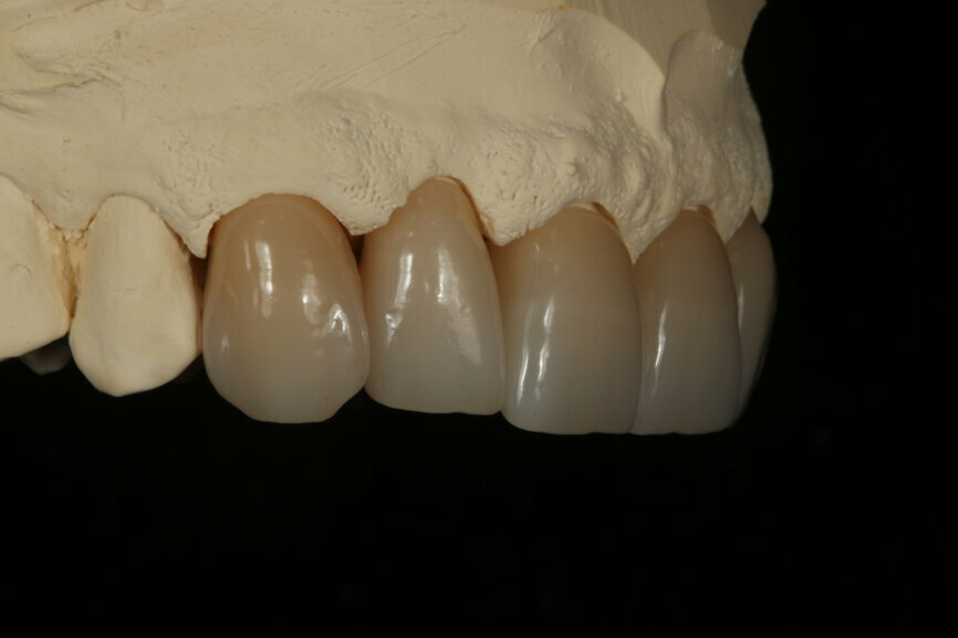 Fig. 6: Lateral view of the final restorations from the left.