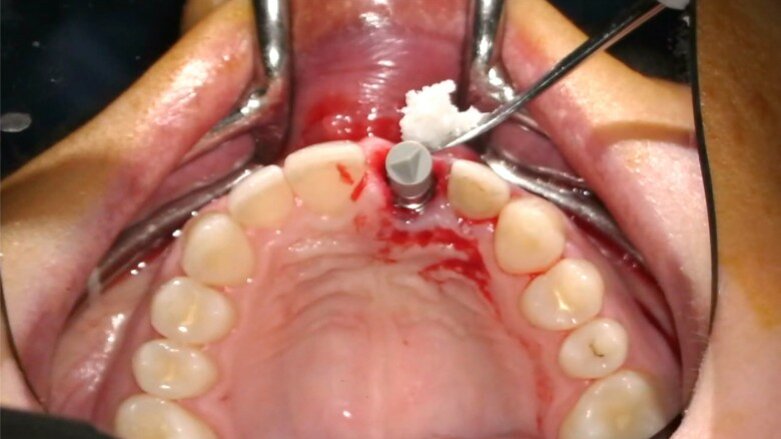 Gestione dei tessuti molli peri-implantari in pazienti con sorriso gengivale