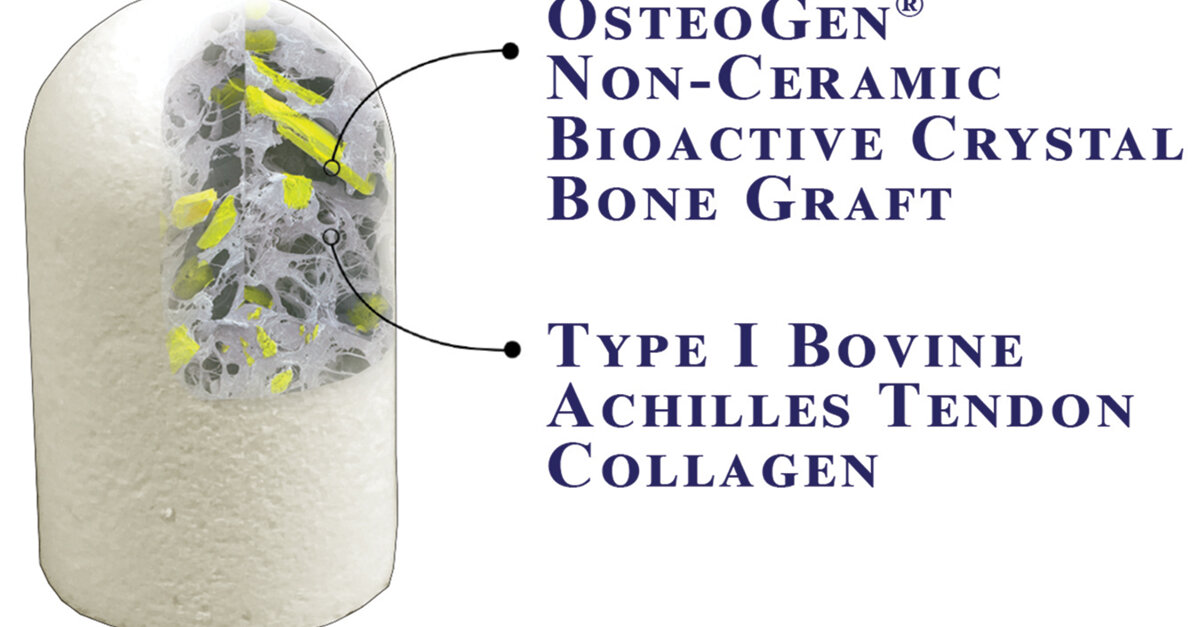 The OsteoGen Plug Onestep bone grafting solution for socket