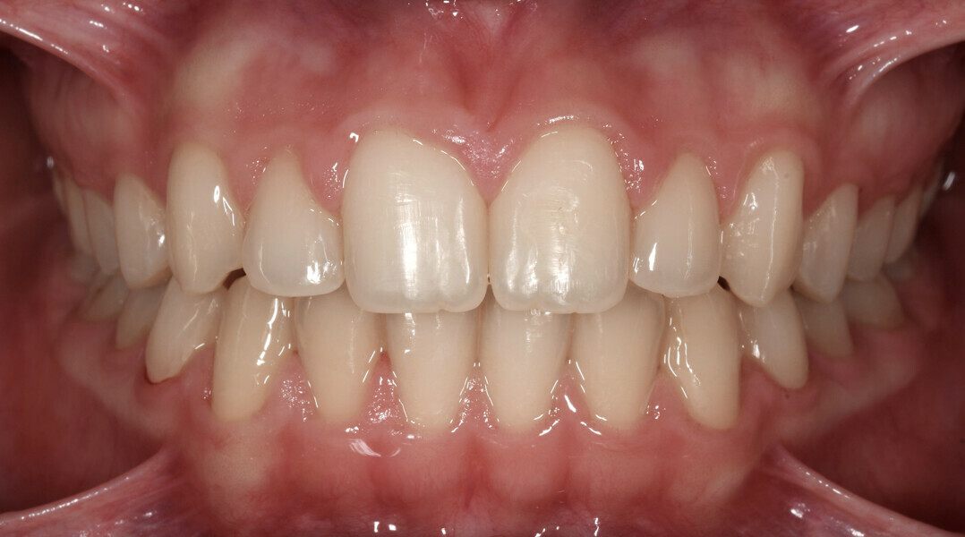 Fig. 23: Final intra-oral photograph. 