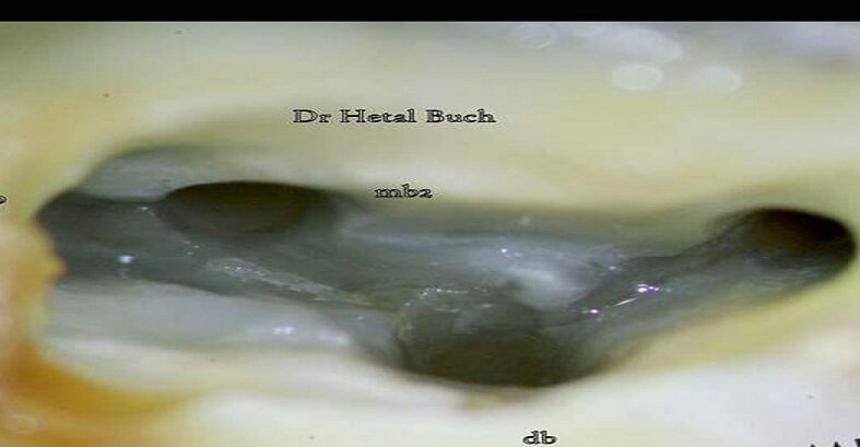 Maxillary Molar Canals as sen under a microscope