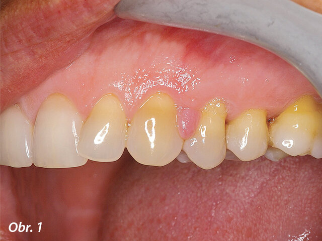 Hutná hyperplastická tkáň interproximálně mezi zuby 23 a 24. Hyperplasticky změněná tkáň omezovala přístup do interdentálního prostoru, v důsledku čehož nebyla pacientka schopna provádět v inkriminované oblasti řádnou ústní hygienu.