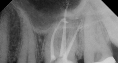 Answers to common clinical endodontic questions: Three basic concepts explained