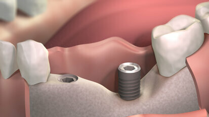Espera-se que o novo material de revestimento acelere a regeneração óssea para procedimentos de implantes dentários