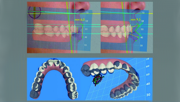 Analyse esthétique dento-faciale au moyen d’un logiciel tridimensionnel (3D) Synergie entre dentisterie esthétique et médecine esthétique