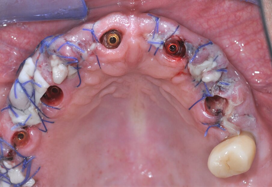 Fig. 4_Foto intra-orale a 24 ore dalla chirurgia dove si apprezzano i siti di preservazione dei tessuti con L-PRF.