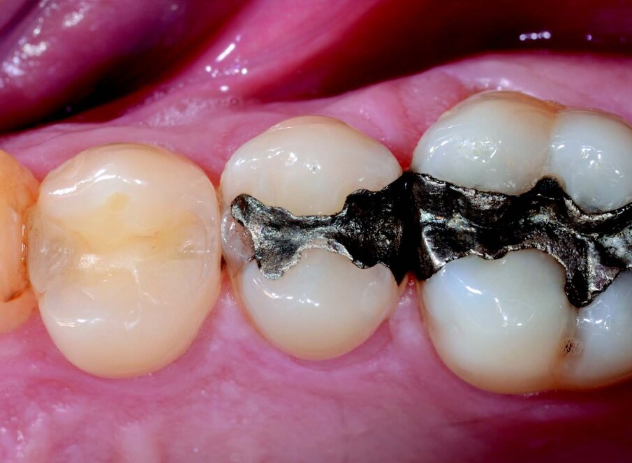 Pre-op situation. Patient needs to replace an old amalgam restoration on 1.5.