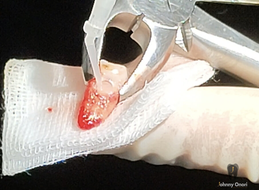 Figg. 4a, 4b - Estrusione chirurgica e sigillatura del riassorbimento. L’acido tricloracetico è stato applicato con un batuffolo di cotone per rimuovere tutto il tessuto riassorbitivo (a). Infine, la cavità è stata riempita con Geristore (DenMat) (b).