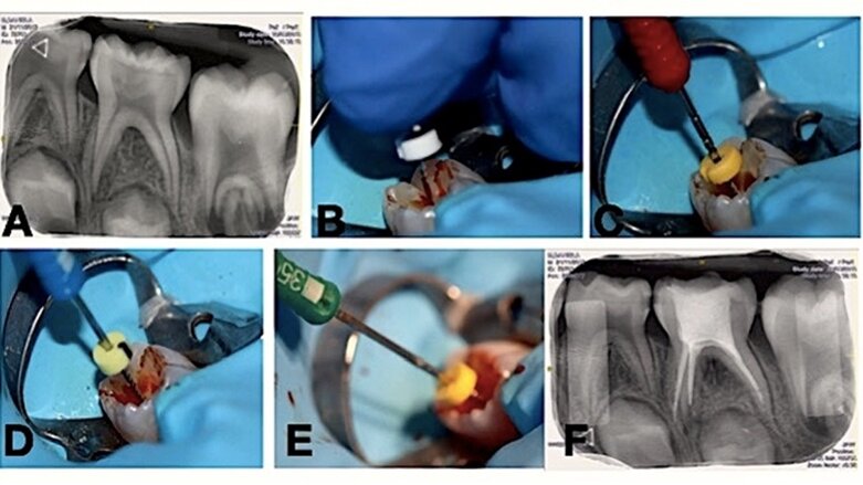 Comparación de pulpectomías en molares temporales con lima manual y reciprocante