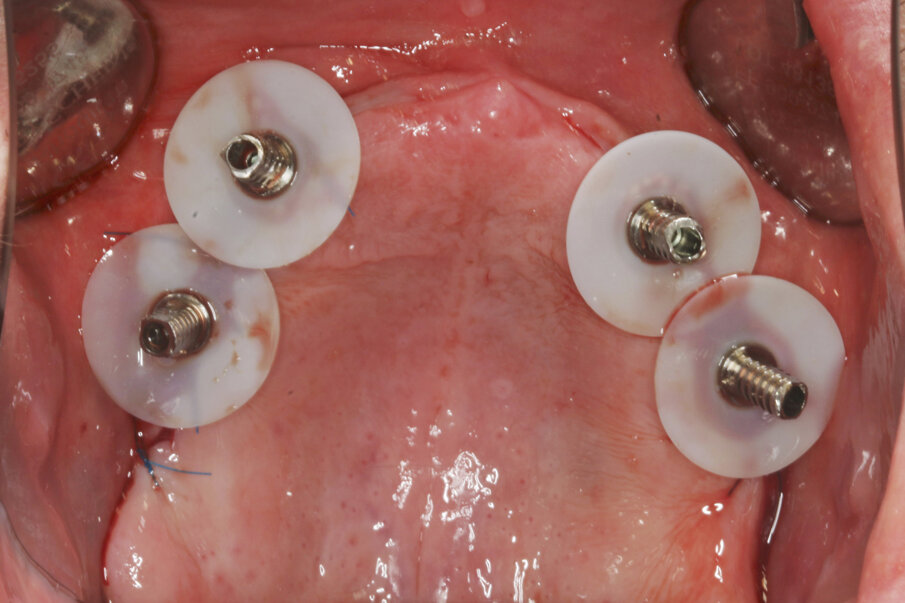 Fig. 9: Temporary cylinders prepared with SynCone silicone sleeves (Dentsply Sirona) for intra-oral gluing.