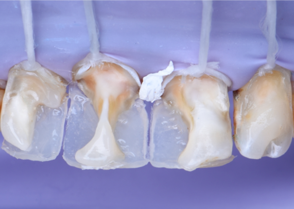 Step 5 – Bonding - palatal wall & build up The Adhesive system was applied (Prime& Bond univarsalTM) and light-cured. Build up of the palatal wall using the silicon key, the proximal wall contours were created using sectional matrix. Dentine shade (ceram.x® duo D3) and enamel shade (ceram.x® duo E2) were used.
