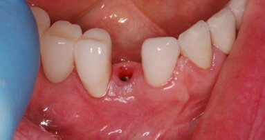 Komplikacje implantoprotetycznej rekonstrukcji braków zębowych – opis przypadku