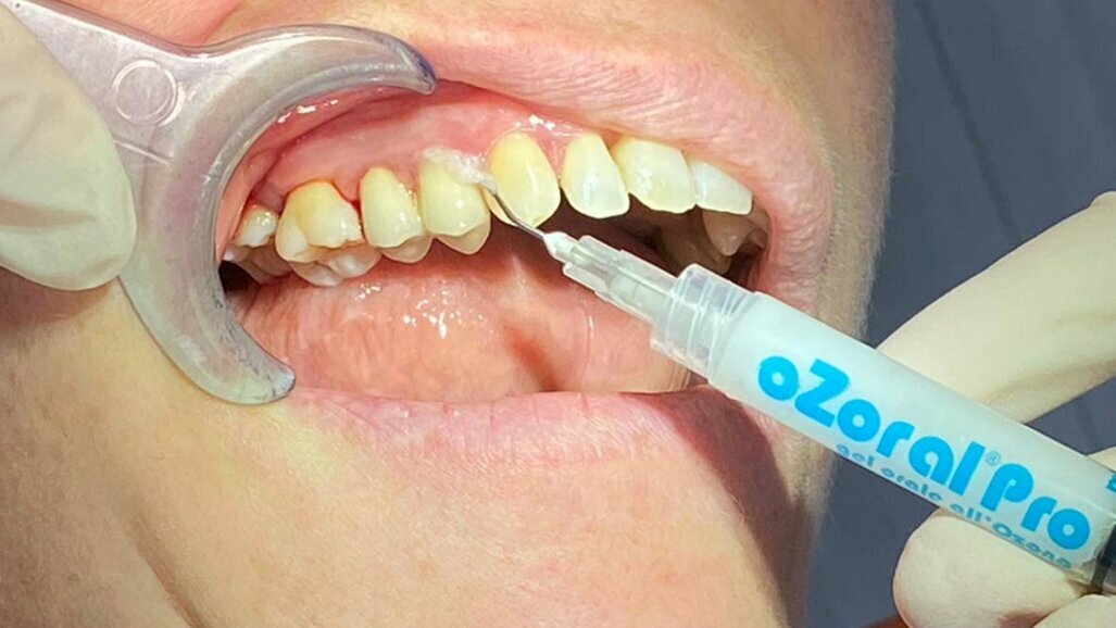 Olio ozonizzato: the new tendency  in Oral Care