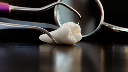 Medicii stomatologi extrag cu succes celulele stem din al treilea molar