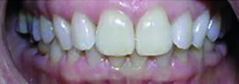 Fig. 1 : Prétraitement et photographies intraorales du visage et des dents antérieures (notez le recouvrement incisif important).