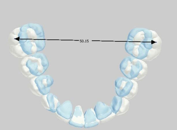 Fig. 2_Setup finale della correzione dell’arcata inferiore: nell’immagine è rappresentato in blu la posizione iniziale della dentatura, in bianco la posizione risultante dal setup. La lunghezza trasversale prevista a fine terapia sarà di 50 mm.