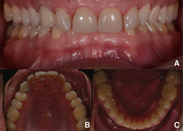 Fig. 1. Fotografías intraorales iniciales, vista frontal (A), vista oclusal del maxilar (B) y vista oclusal de la mandíbula (C).